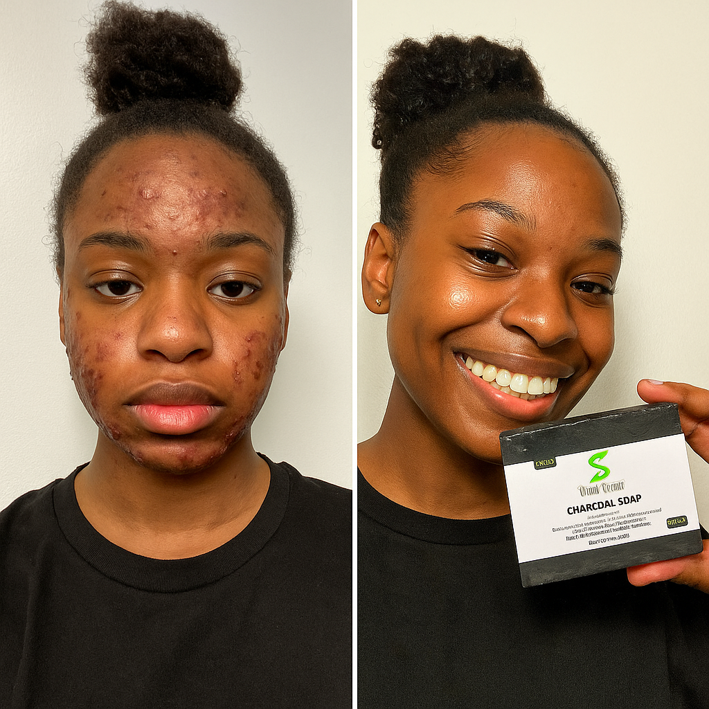 Charcoal Soap For Acne, Oily Skin, Dark Spots, & Blemishes, For Both Men & Women, Made With Aloe Vera, Activated Charcoal, Vitamin E, & Tea Tree Blend- Paraben-Free (Pack of 4 Units)