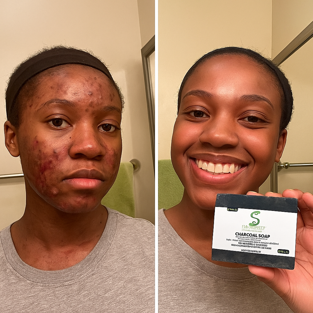 Charcoal Soap For Acne, Oily Skin, Dark Spots, & Blemishes, For Both Men & Women, Made With Aloe Vera, Activated Charcoal, Vitamin E, & Tea Tree Blend- Paraben-Free (Pack of 4 Units)