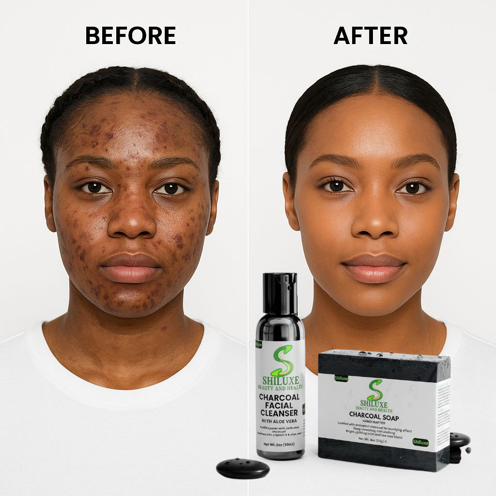 Charcoal Soap & Facial Cleanser For Acne, Oily Skin, Dark Spots, & Blemishes, For Both Men & Women, Made With Aloe Vera, Activated Charcoal, Vitamin E, & Tea Tree Blend- Paraben-Free (Pack of 2)