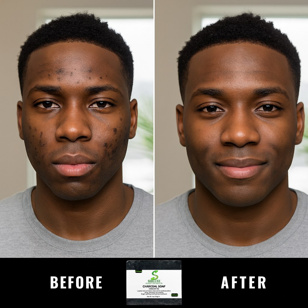 Charcoal Soap Bar for Acne, Black Spots, Blemishes_ For Face & Oily Skin, 4 Oz. Handcrafted with activated Charcoal, Organic Ingredients & Essential Oils