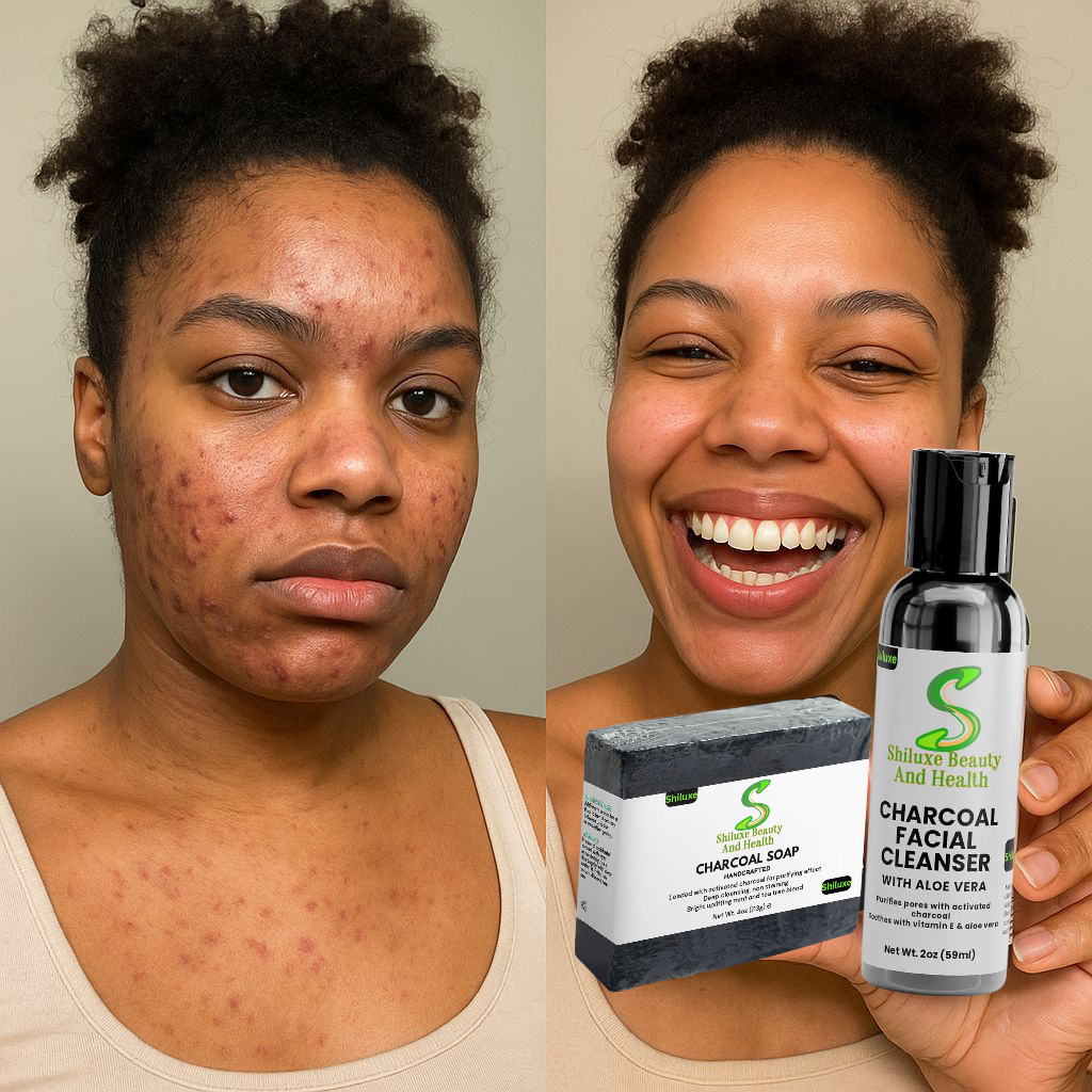 Charcoal Soap & Facial Cleanser For Acne, Oily Skin, Dark Spots, & Blemishes, For Both Men & Women, Made With Aloe Vera, Activated Charcoal, Vitamin E, & Tea Tree Blend- Paraben-Free (Pack Of 2 Units Of Each)